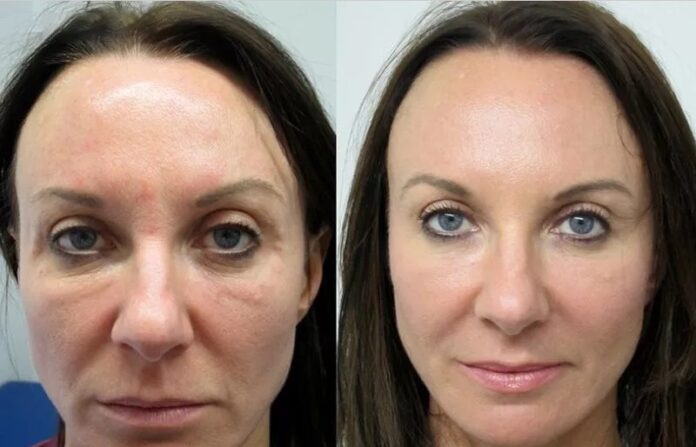 How Long Does It Take To See Results From Vampire Facelift?