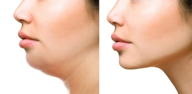 What Are The Differences In Outcomes Between Facial Liposuction Procedures?