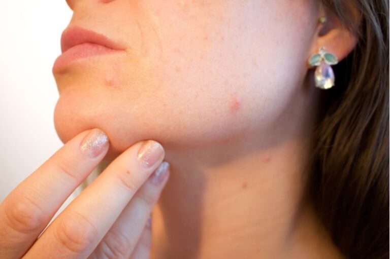 How does Light Therapy Help Acne?