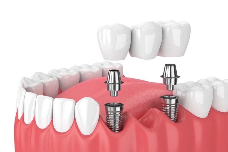The Average Cost of Full Mouth Dental Implants