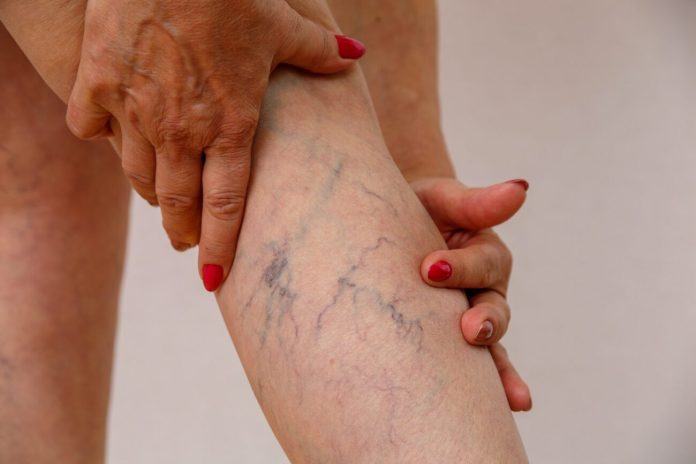 Effective Solutions for Varicose Vein Removal: The Ultimate Guide